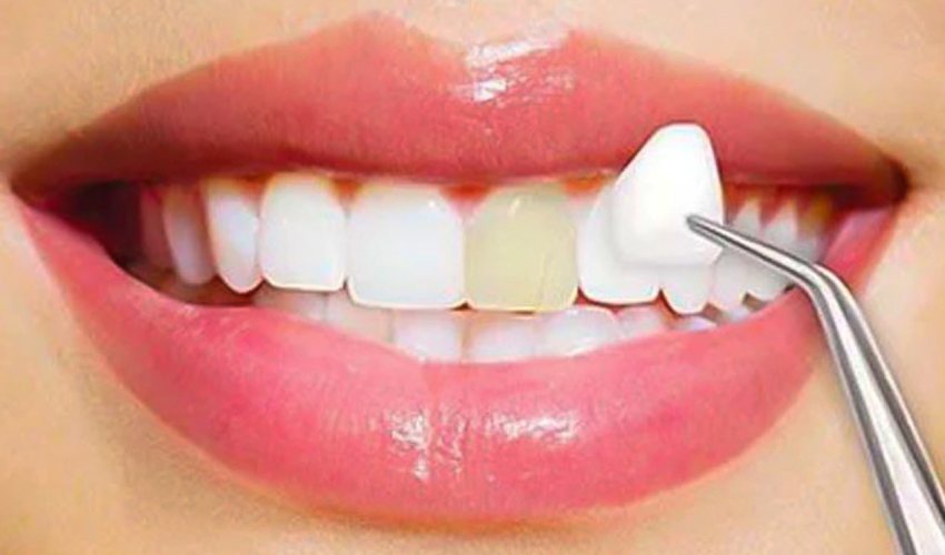 Dental Veneers