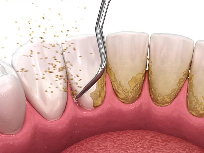 Periodontal Disease